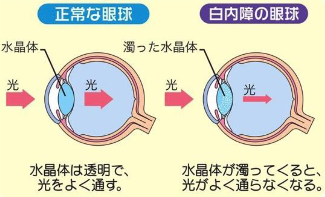 白内障の眼球について