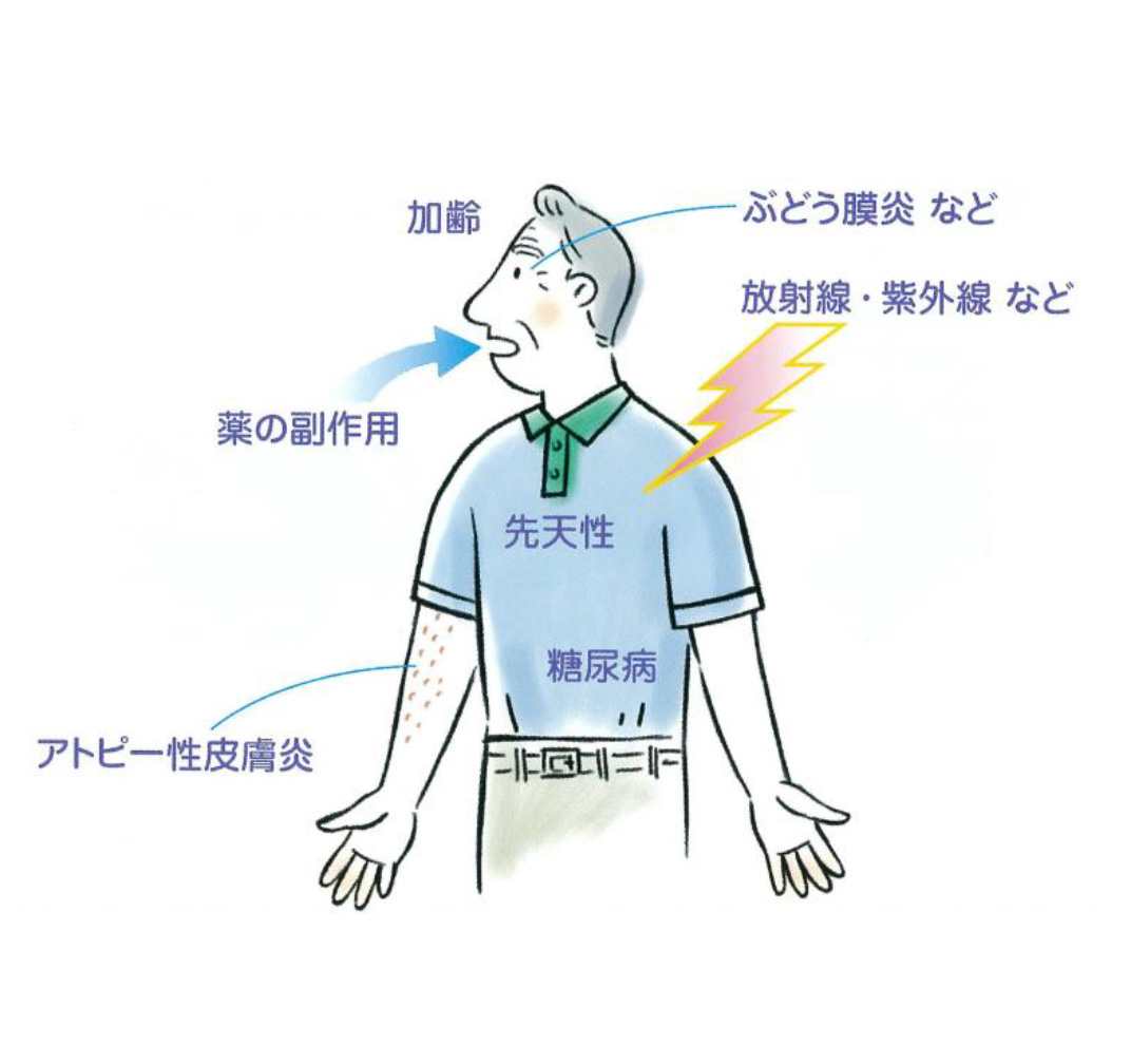 白内障の種類と原因