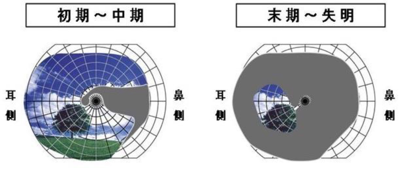 緑内障による視野欠損（初期～失明）