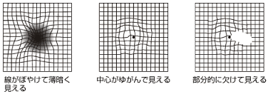 加齢黄斑変性 | 長久手市下山 藤が丘駅近くの眼科｜きとう眼科クリニック